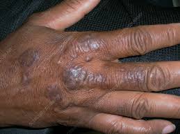 Image result for Lichen Simplex Chronicus