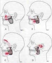 Pin On Migraine Remedies