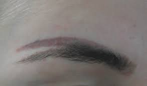 However, the active laser removal method, although a bit on the expensive. Eyebrow Tattoo Removal Can Eyebrow Tattoos Be Removed By Laser Andrea Catton Laser Clinic