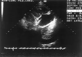 It does tell you that it's going to be more difficult to do a thoracentesis, to actually. Pleural Effusion On Transthoracic Echocardiogram Circulation