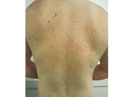This is then followed, days to weeks later, by a rash of many similar but smaller round or oval lesions, mainly on the trunk and upper limbs. Pityriasis Rosea