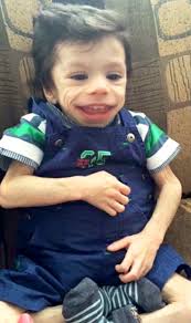 Orphan Who Weighed 8 Pounds at Age 7 Undergoes Transformation