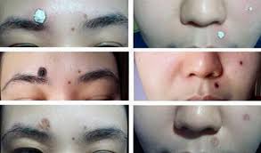Miracle Cream Krim Penanggal Tahi Lalat Miracle Cream Krim Penanggal Tahi Lalat
