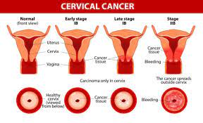 Before i was diagnosed, i had. Cervical Cancer Healthinfi