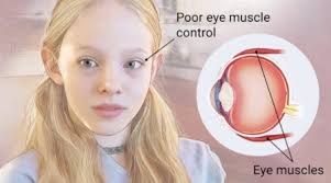 Check spelling or type a new query. Strabismus Misaligned Eyes Services Cataract Laser Institute Eye Doctor In Medford Oregon