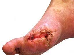 What should you do when these signs and symptoms are present, the injury should always be treated as a fracture or. Gangrene Causes Symptoms And Treatment