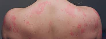 Allergic Reaction To Waxing Here S How To Handle It