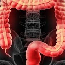 La malattia diverticolare (md) è la più comune patologia colica nel mondo occidentale, con un'incidenza di oltre il 60% in. Nkfpivlzamblm