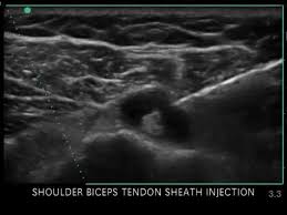 Image result for Biceps Tendon Injection