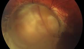 Image result for Coloboma