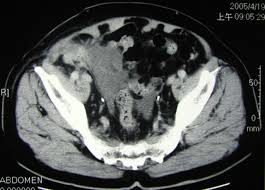 A hernia happens anytime a body part pushes into a place where it doesn't belong. Ruptured Appendiceal Cystadenoma Presenting As Right Inguinal Hernia In A Patient With Left Colon Cancer A Case Report And Review Of Literature Bmc Gastroenterology Full Text