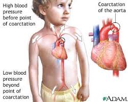 Coarctation Of The Aorta Medlineplus Medical Encyclopedia