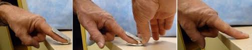It also tells you what you should and should not do. Mallet Finger Baseball Finger Orthoinfo Aaos