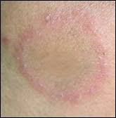 Les points rouges sur le corps peut être nuisible aussi bien comme absolument bénigne. Taches Rouges Sur La Peau Traitement Herpes Circine Dr Abimelec