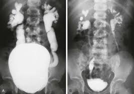 Image result for Voiding Cystourethrogram
