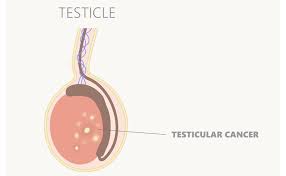 Consult a doctor for medical advice. 6 Clinical Signs Of Testicular Cancer Saudi German Health