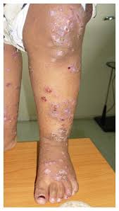 Image result for scabies effects on the human body