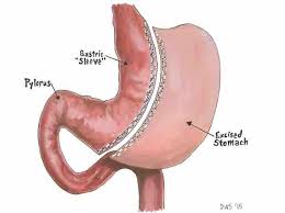 gastric sleeve surgery all you need