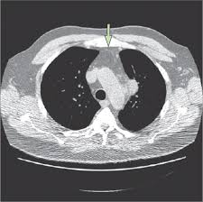 Image result for Rhodococcus equi