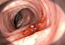 How will i be monitored over time? What You Can Do To Catch Colon Cancer Early Health Essentials From Cleveland Clinic