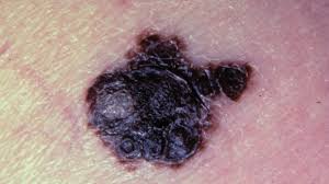 A diagnosis of lung cancer naturally causes some overwhelming emotions, but you don't have to let those emotions get the best of you. Symptoms And Pictures Of Stage 4 Melanoma