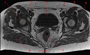 12 photos of the muscle anatomy of upper thigh. Mri Of The Hip Detailed Anatomy W Radiology