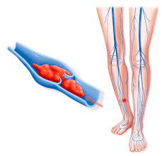 Can You Wear Compression Socks All Day Improve Your Health