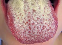 Image result for Oral thrush roof of mouth