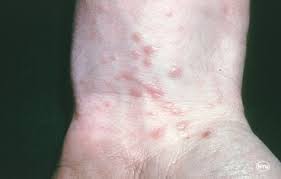 Cutaneous lichen planus, oral lichen planus, vulval lichen planus, mucosal lichen planus, lichen planopilaris, nail lichen planus, lichen planus pigmentosus, lichenoid drug eruption, hypertrophic. Lichen Planus Pariser Dermatology