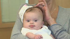 Signs and symptoms of a brain tumor in children vary greatly and depend on the brain tumor type, size, location and rate of growth. Baby With Fatal Brain Tumor Will Live Doctor Says Abc7 San Francisco