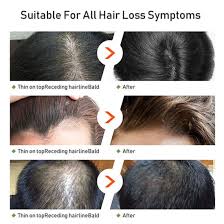 With chiltanpure wonderful biotin hair serum, you can finally help give yourself the dense and lustrous hair you always wanted. Custom Best Hair Loss Treatment Biotin Hair Growth Serum Kit China Hair Growth Serum And Hair Serum Growth Price Made In China Com