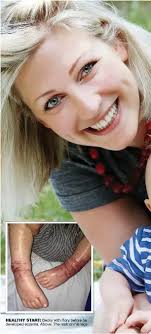 Our poor boy had scratched himself raw. It was like a scene from a horror  movie