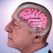 How do alzheimer's patients die. Alzheimer S Disease Fact Sheet National Institute On Aging