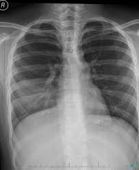 Mucous Plugging Right Middle Lobe Collapse Gross Middle Lobe Collapse Is Associated With A Filling Radiology Radiology Imaging Human Anatomy And Physiology