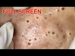 But the damage was already done to the facility. Large Blackheads Removal Best Pimple Popping Videos Youtube