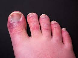 Image result for Chilblains