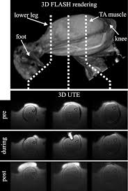 Applications for magnetic resonance imaging (mri) of the foot and ankle disorders have expanded dramatically in the last decade.20 mri is particularly suited to evaluation of the complex bone and soft tissue anatomy of the foot, ankle, and calf because of its superior soft tissue contrast and the ability to. Plos One A Mri Compatible Combined Mechanical Loading And Mr Elastography Setup To Study Deformation Induced Skeletal Muscle Damage In Rats