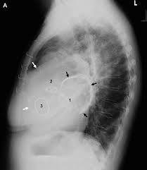 Image result for XRay Changes in Rheumatic Conditions