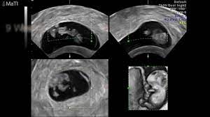 The baby's nervous system is already developing, and the foundations for its major organs are in place. Baby Ultrasound Early Pregnancy 5 6 7 8 9 Weeks 3d Youtube