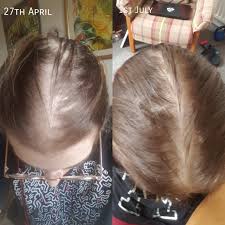 Treating your pcos can help get rid of excess facial hair, dr. Reversing Hair Loss Album On Imgur