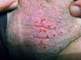 Herpes | the most comprehensive educational site. Herpes Hsv 2 Infection
