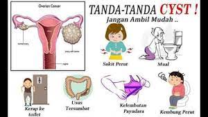 Akan tetapi berkenaan dengan kapan terjadinya, (hari, tanggal, bulan dan. Tanda Tanda Awal Cyst Wajib Tahu Dan Eva Emily Clinic Facebook