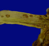 Trichinosis: clinicopathological case