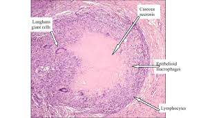 Looking for online definition of necrosis in the medical dictionary? Microscopic Appearance Of Caseous Necrosis A Well Formed Granuloma Download Scientific Diagram