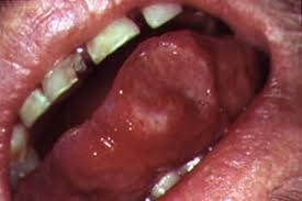 Image result for Canker sores roof of mouth