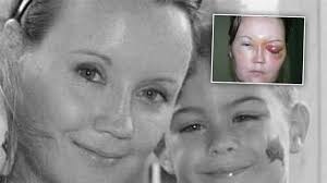 Lensi bir gözünü kör etti