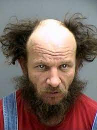 Bald Old Man Hair Loss Treatment Hair Treatment Thinning Hair Loss