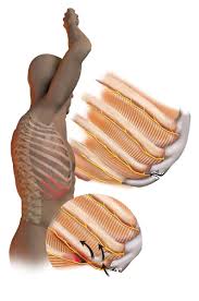 Rib cage pain is a common issue that can result from a variety of factors. Surgical Management Of Slipping Rib Syndrome Penn Medicine