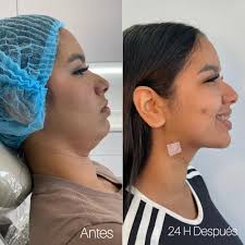 Que opinas de este cambio de perfilacion láser? #lipopapada #perfilaci...