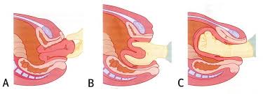 Image result for Uterine Inversion